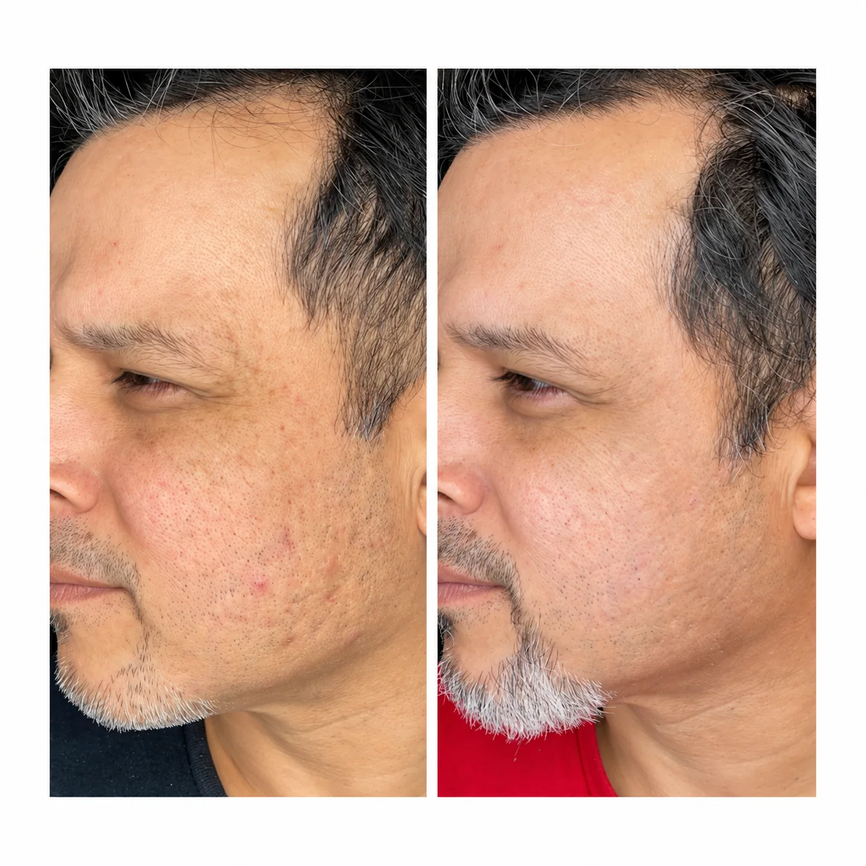 Before-and-after photo of acne scar treatment