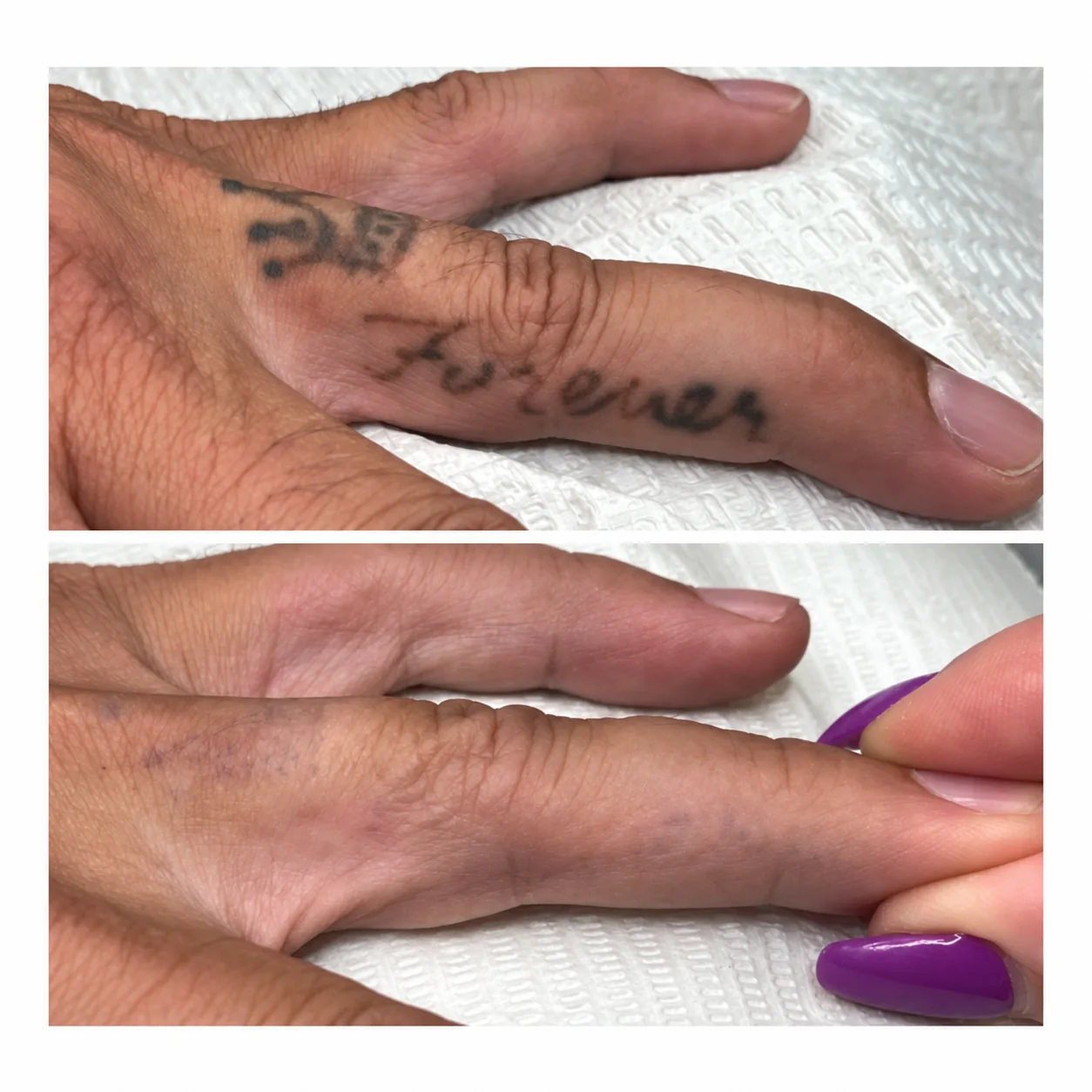 Before-and-after photo of body tattoo removal