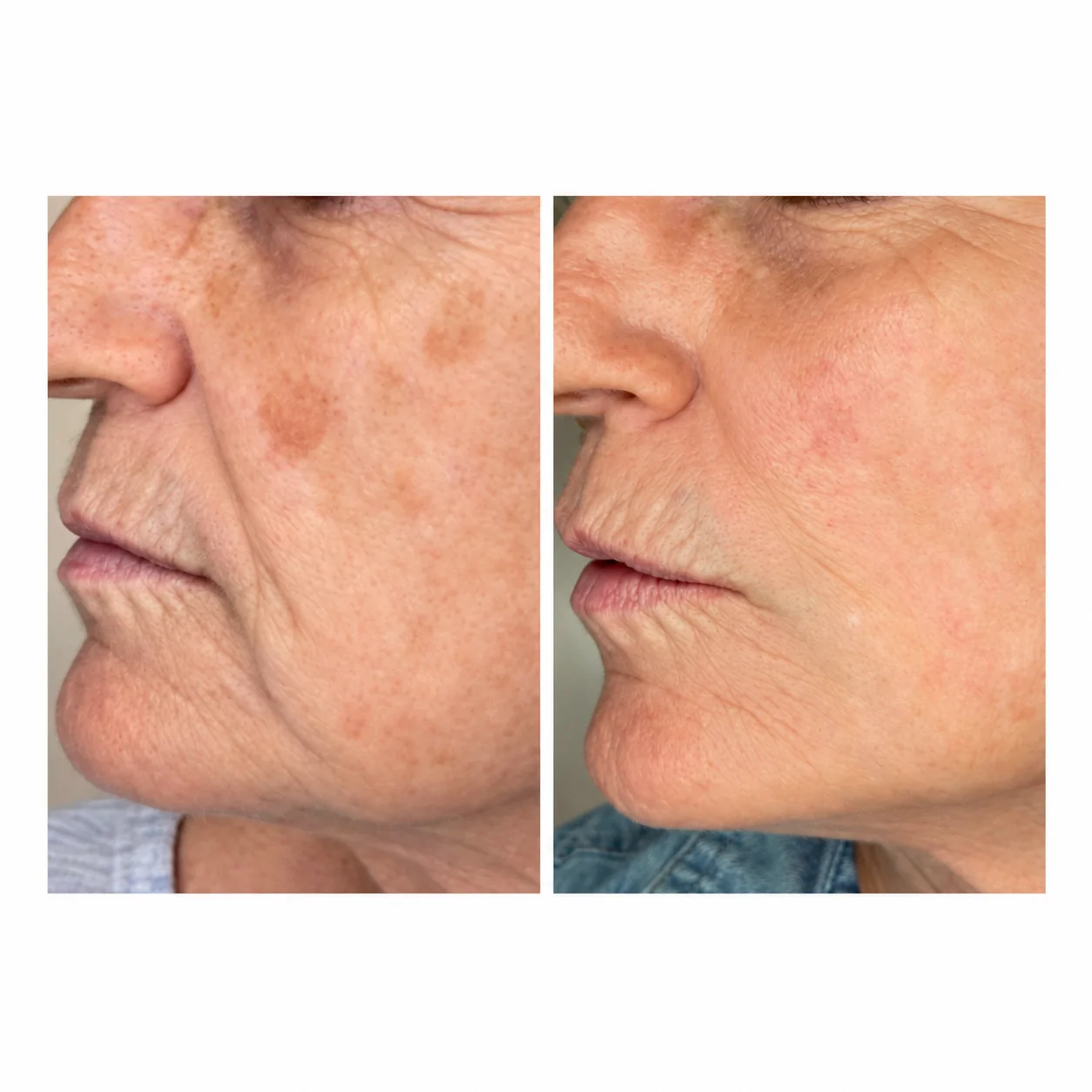 Before-and-after photo of Pico Genesis skin rejuvenation